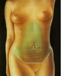 intervenciones_abdominoplastia_2.jpg