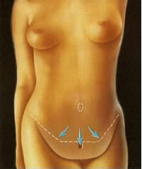 intervenciones_abdominoplastia_4.jpg