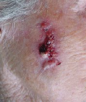 procedimientos_cancer_cutaneo_carcioma_espinocelular.jpg