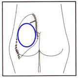 protesis_de_gluteos_2.jpg