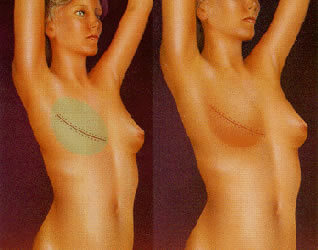reconstruccion_de_mama_2.jpg