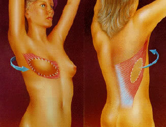 reconstruccion_de_mama_3.jpg