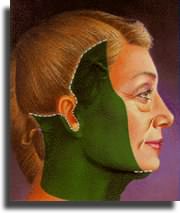 Las incisiones suelen colocarse en el pelo, delante de la oreja y detr�s de �sta.