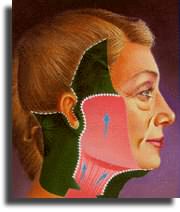 El tejido de la cara y el cuello y la musculatura son separados para conseguir un estiramiento adecuado