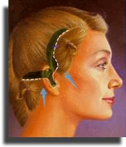 El exceso de piel es eliminado.