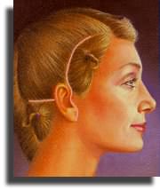 Incisiones resultantes.